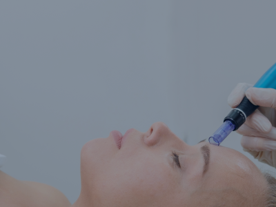 microneedling